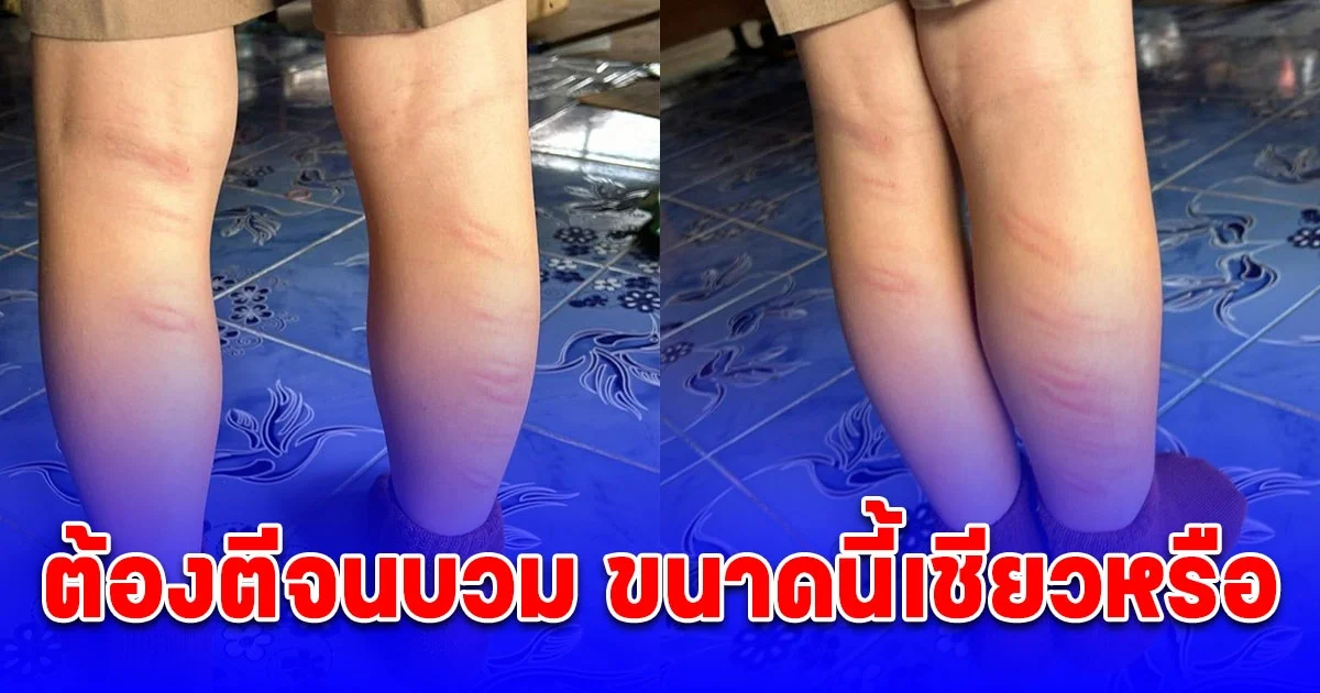 ด.ช.โดนลงโทษด้วยการตี 25 ครั้ง สาเหตุเพราะไม่มีอุปกรณ์การเรียน