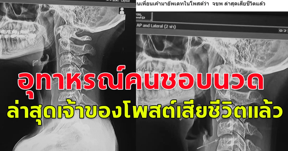 อุทาหรณ์คนชอบนวด สาวแชร์ประสบการณ์หลังจากไปนวดแล้วปวดท้ายทอย ล่าสุดเจ้าของโพสต์เสียชีวิตแล้ว