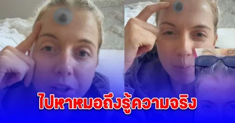 หญิงออสซี่มีสิวขึ้นที่หน้าผาก ไม่หายสักที ตัดสินใจไปหาหมอเป็นมะเร็งผิวหนัง