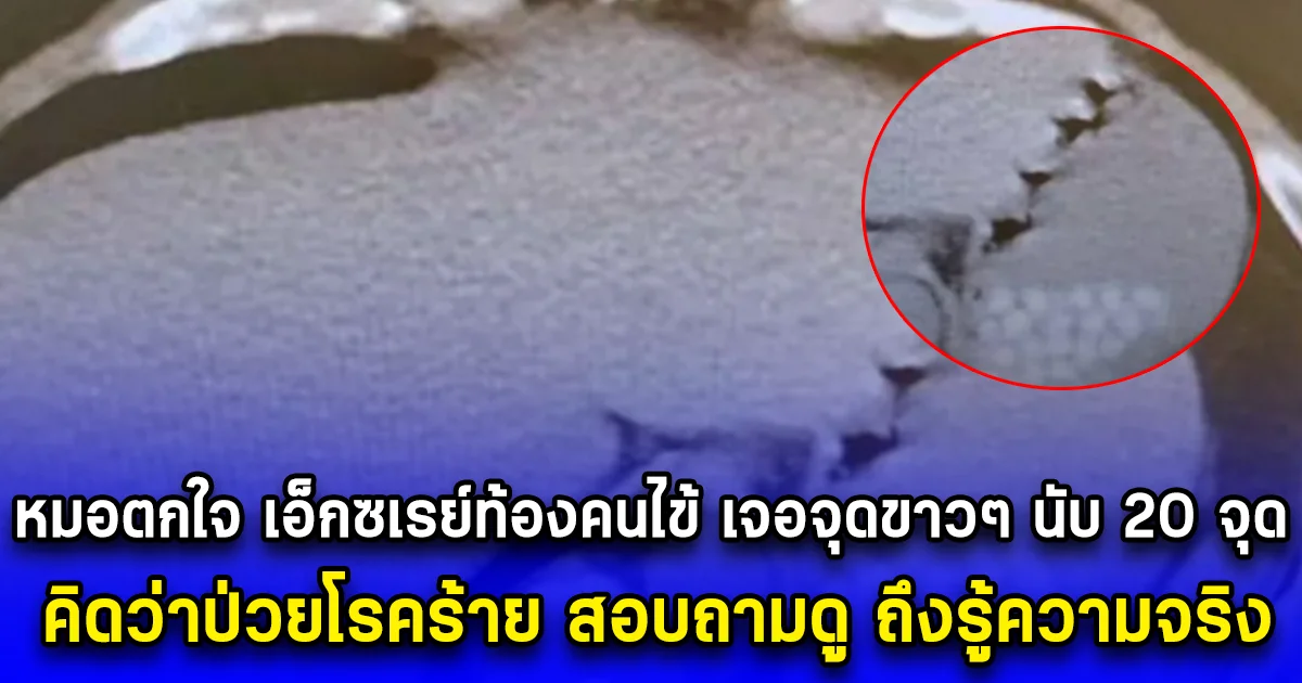 หมอตกใจ เอ็กซเรย์ท้องคนไข้ เจอจุดขาวๆ นับ 20 จุด คิดว่าป่วยโรคร้าย สอบถามดู ถึงรู้ความจริง (ตปท.)