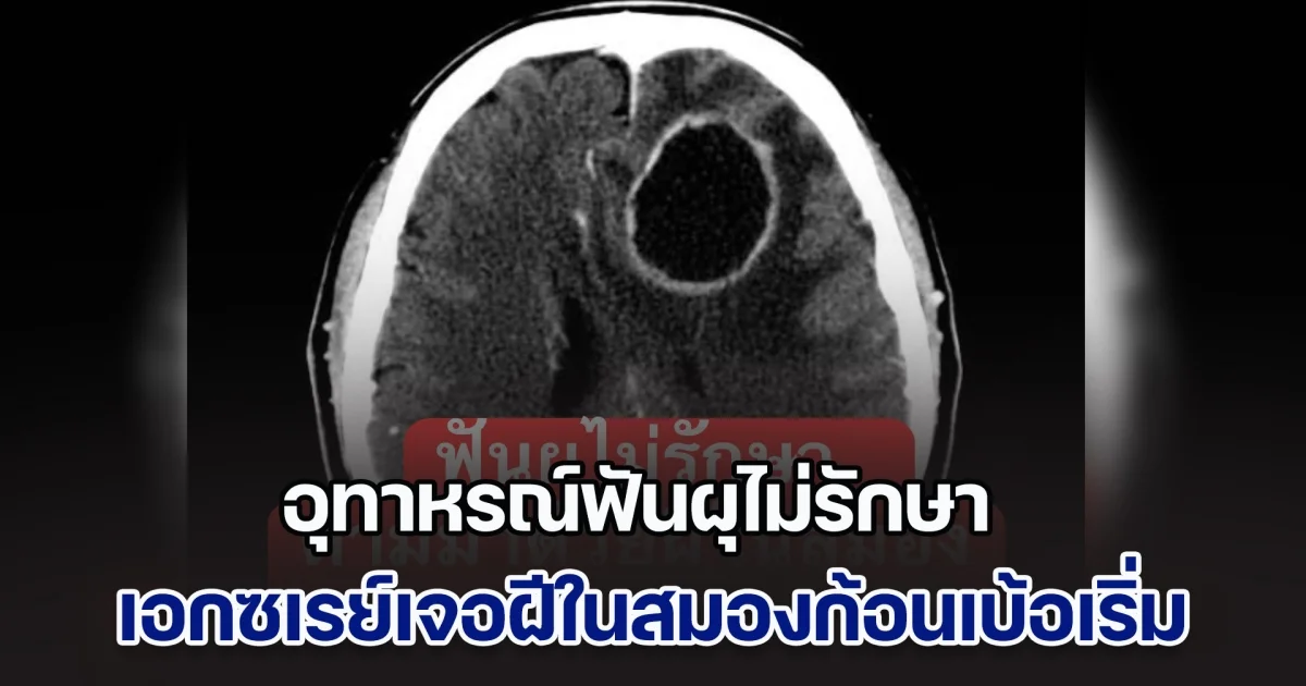 อุทาหรณ์ฟันผุไม่รักษา หมอสมองเผย เคสคนไข้อ่อนแรง คิดว่าเป็นสโตรก เอกซเรย์เจอฝีในสมองก้อนเบ้อเริ่ม