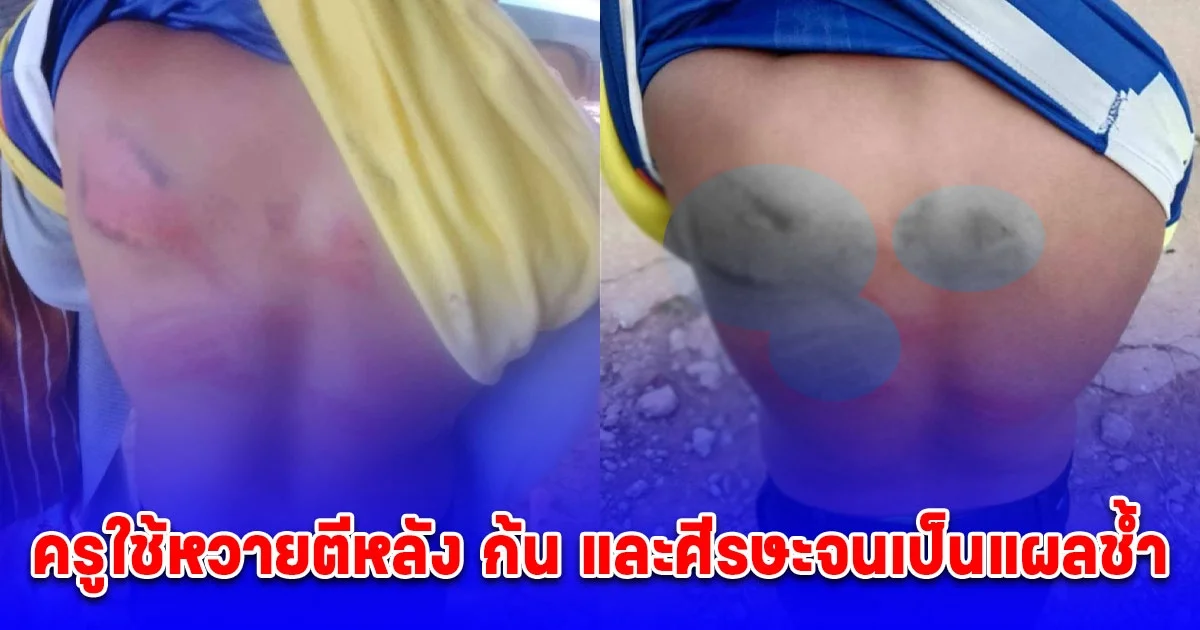 แม่แจ้งความ ครูใช้หวายตีหลัง ก้น และศีรษะลูกชายจนเป็นแผลช้ำไปทั้งตัว ครูขอเยียวยา 30,000 บาท