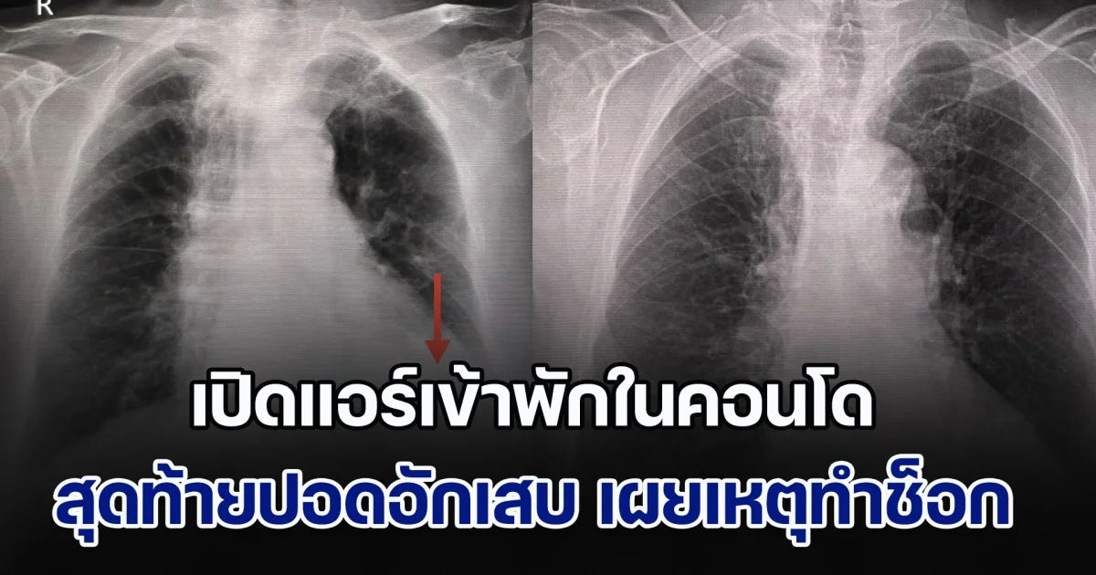 หมอเผยเคส เปิดแอร์เข้าพักในคอนโด สุดท้ายปอดอักเสบ พอไล่หาสาเหตุถึงได้รู้ หลายคนต้องระวัง