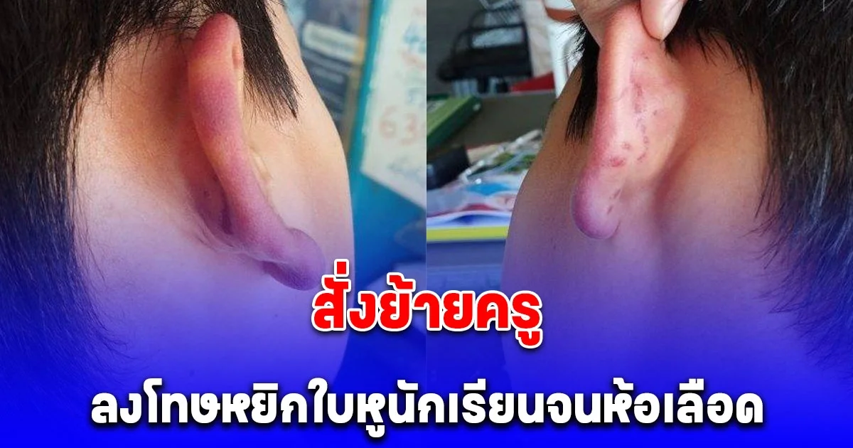 สั่งย้ายครู ลงโทษให้เพื่อนหยิกใบหูนักเรียน ป.3 จนอักเสบห้อเลือด