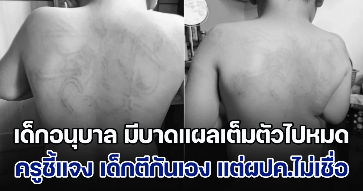 ถกสนั่น! เด็กอนุบาล มีบาดแผลเต็มตัวไปหมด ครูชี้แจง บอกเด็กตีกันเอง แต่ผปค.ทั้ง 2 ฝ่ายติดใจ ไม่อยากเชื่อ