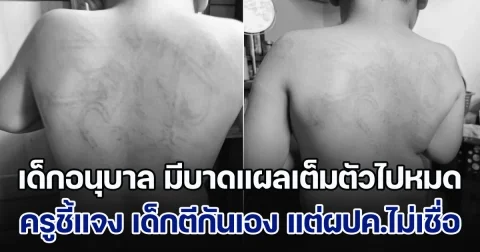 ถกสนั่น! เด็กอนุบาล มีบาดแผลเต็มตัวไปหมด ครูชี้แจง บอกเด็กตีกันเอง แต่ผปค.ทั้ง 2 ฝ่ายติดใจ ไม่อยากเชื่อ