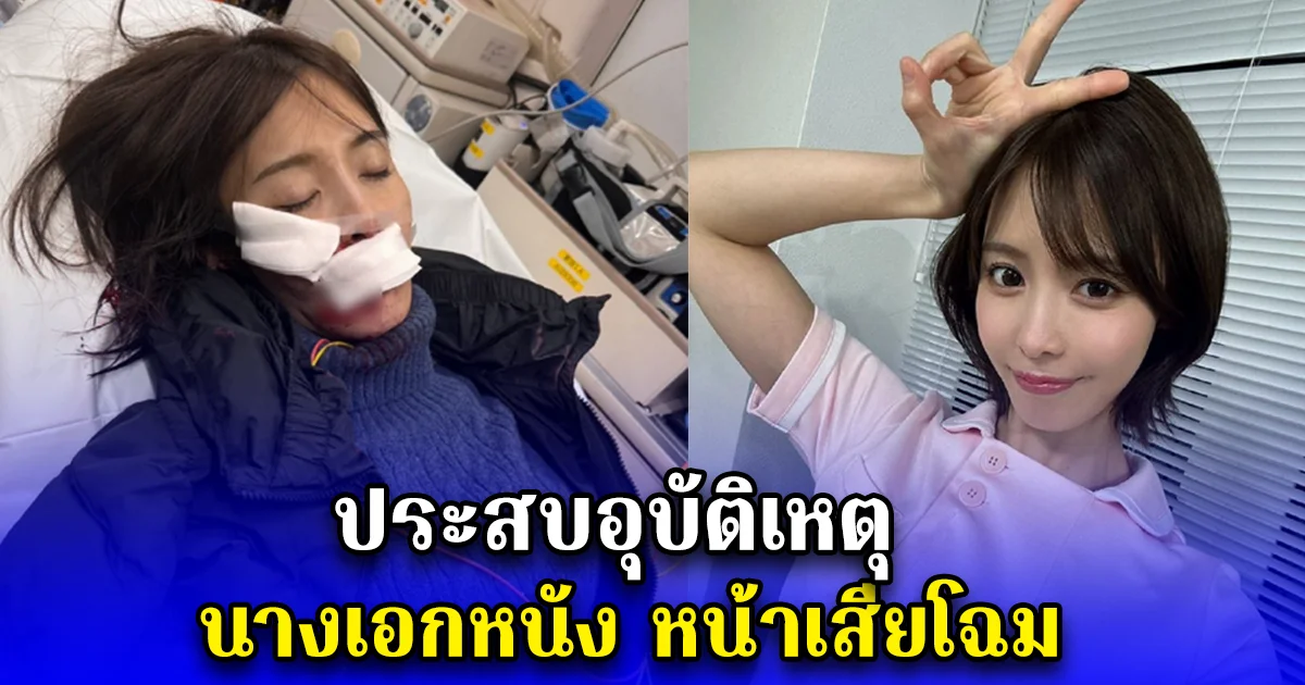 ประสบอุบัติเหตุ นางเอกหนัง หน้าเสียโฉม (ตปท.)