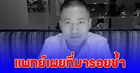 แพทย์เผยที่มารอยช้ำ ผู้กำกับโจ้