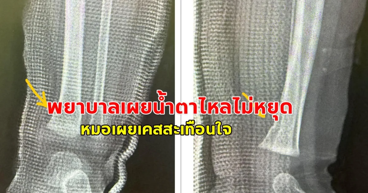 พยาบาลเผยน้ำตาไหลไม่หยุด หมอเผยเคสสะเทือนใจ หนูน้อยวัย 9 เดือนรอดชีวิตเพียงคนเดียว หลังพ่อแม่และยายเสียชีวิตคาที่จากอุบัติเหตุ