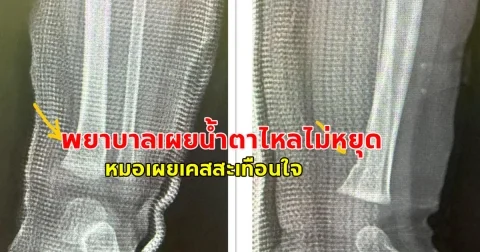 พยาบาลเผยน้ำตาไหลไม่หยุด หมอเผยเคสสะเทือนใจ หนูน้อยวัย 9 เดือนรอดชีวิตเพียงคนเดียว หลังพ่อแม่และยายเสียชีวิตคาที่จากอุบัติเหตุ