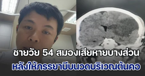 อย่าไว้ใจให้เมียนวด! แพทย์แชร์อุทาหรณ์ คนไข้ชายวัย 54 สมองเสียหายบางส่วน ทำแขนขาข้างขวาอ่อนแรง และไม่พูด