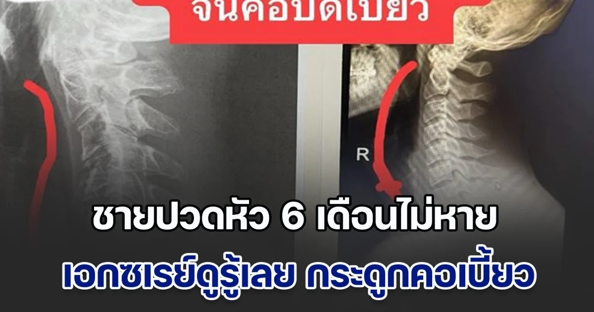 เตือนด่วน! ชายปวดหัว 6 เดือนไม่หาย เอกซเรย์ดูรู้เลย กระดูกคอเบี้ยว แพทย์ ชี้สาเหตุจากสิ่งที่หลายคนทำอยู่ทุกวัน