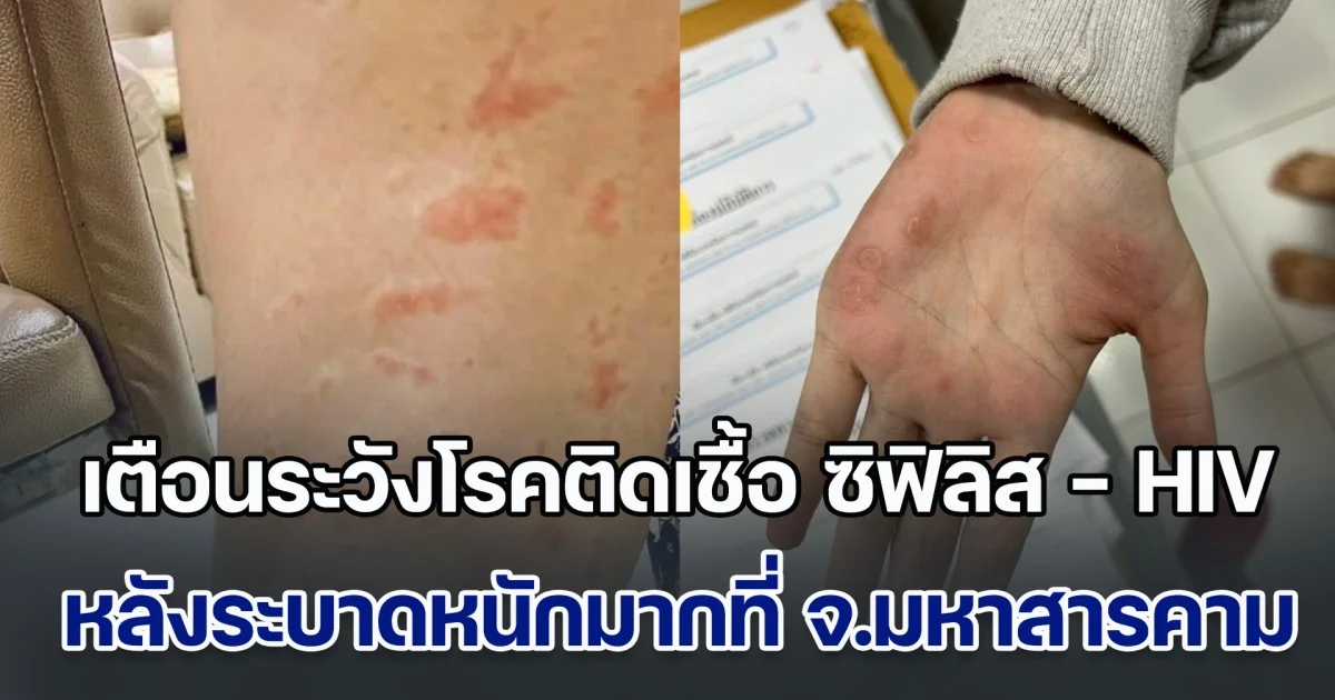 เตือนระวังโรคติดเชื้อ ซิฟิลิส - HIV หลังระบาดหนักมากที่ จ.มหาสารคาม พุ่งสูงแตะเกือบ 500 คน