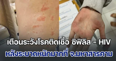 เตือนระวังโรคติดเชื้อ ซิฟิลิส - HIV หลังระบาดหนักมากที่ จ.มหาสารคาม พุ่งสูงแตะเกือบ 500 คน