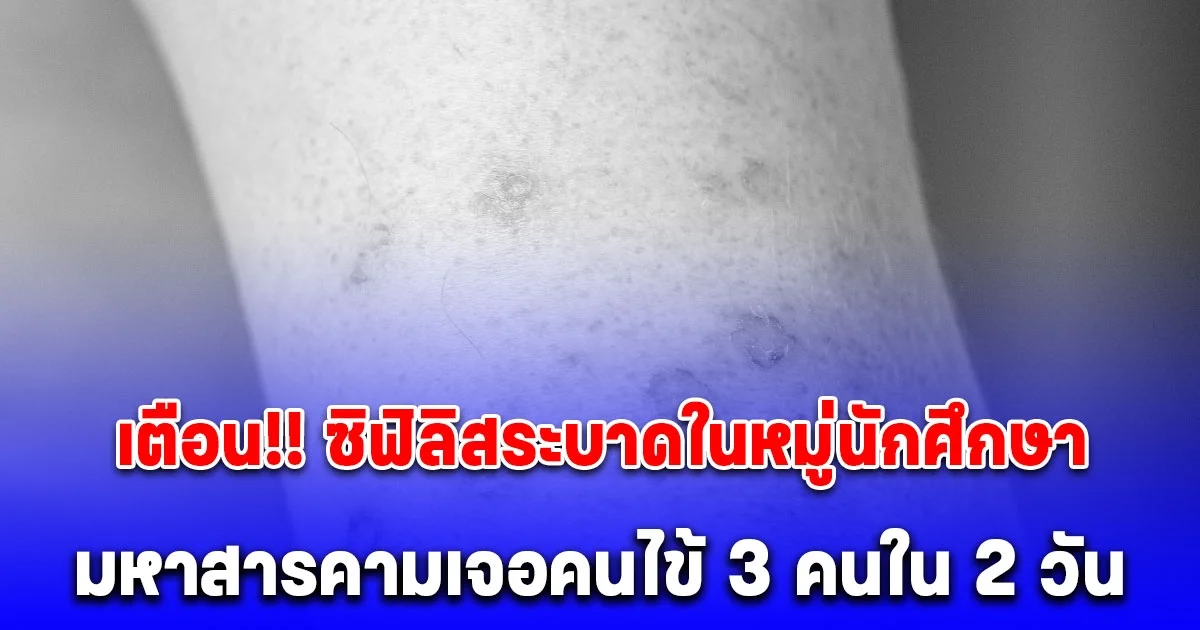 เตือน ซิฟิลิสระบาดในหมู่นักศึกษา เปิดจังหวัดเจอคนไข้ 3 คนใน 2 วัน