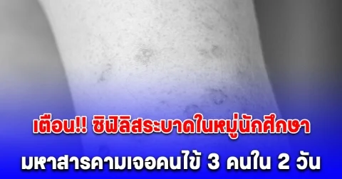 เตือน ซิฟิลิสระบาดในหมู่นักศึกษา เปิดจังหวัดเจอคนไข้ 3 คนใน 2 วัน