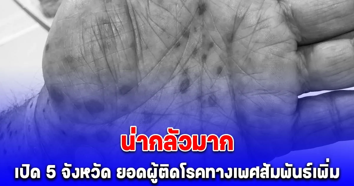 เปิด 5 จังหวัดน่าห่วง ยอดผู้ติดโรคทางเพศสัมพันธ์เพิ่ม พุ่งรวมถึง 50,000 ราย
