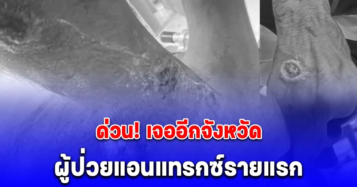 ด่วน! เจออีกจังหวัด ผู้ป่วยแอนแทรกซ์รายแรก ซักประวัติกิน ก้อย ซอยจุ๊ เป็นประจำ