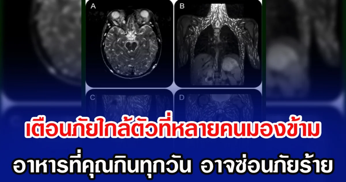 เตือนภัยใกล้ตัวที่หลายคนมองข้าม อาหารที่คุณกินทุกวัน อาจซ่อนภัยร้าย