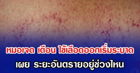 หมอเจดโพสต์เตือน ไข้เลือดออกเริ่มระบาดอีกระลอก  เผย ระยะอันตรายอยู่อยู่ช่วงไหน