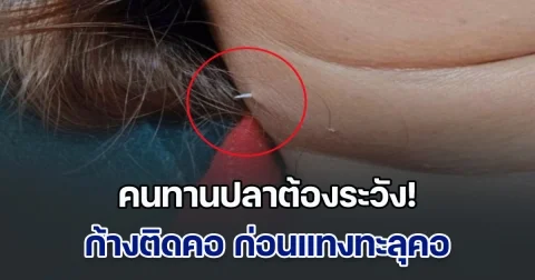 คนทานปลาต้องระวัง! หนุ่มโพสต์เตือน ก้างติดคอ ก่อนแทงทะลุคอออกมา หลังผ่านไปกว่า 2 สัปดาห์