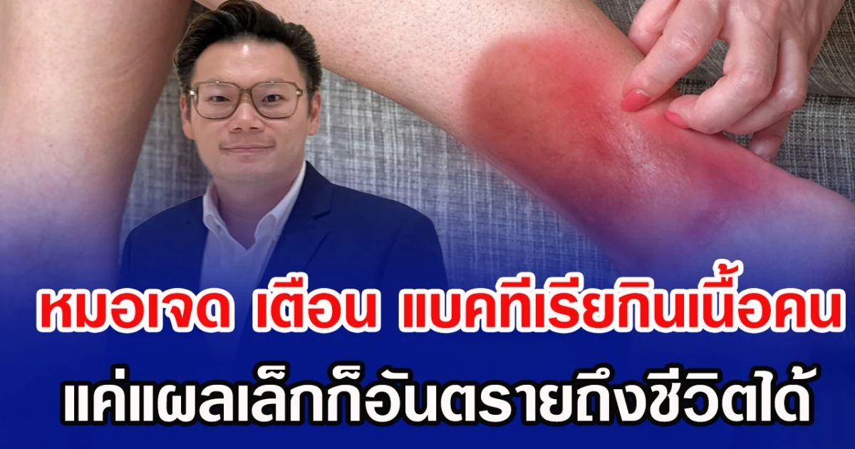 หมอเจด เตือน แบคทีเรียกินเนื้อคน แค่แผลเล็กก็อันตรายถึงชีวิตได้