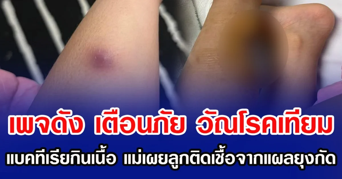 เพจดัง เตือนภัย วัณโรคเทียม  แบคทีเรียกินเนื้อ แม่เผยลูกติดเชื้อจากแผลยุงกัด