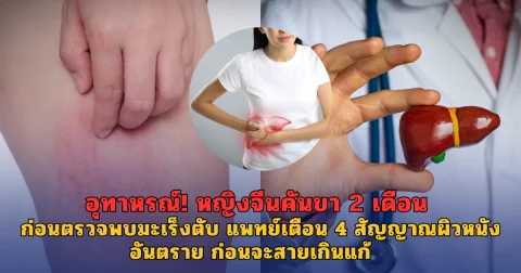 อุทาหรณ์! หญิงจีนคันขา 2 เดือน ก่อนตรวจพบมะเร็งตับ แพทย์เตือน 4 สัญญาณผิวหนังอันตราย ก่อนจะสายเกินแก้ (ตปท.)