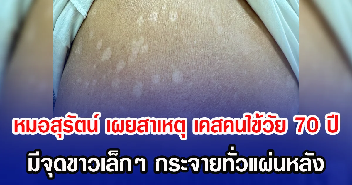 หมอสุรัตน์ เผยสาเหตุ เคสคนไข้วัย 70 ปี มีจุดขาวเล็กๆ กระจายทั่วแผ่นหลัง
