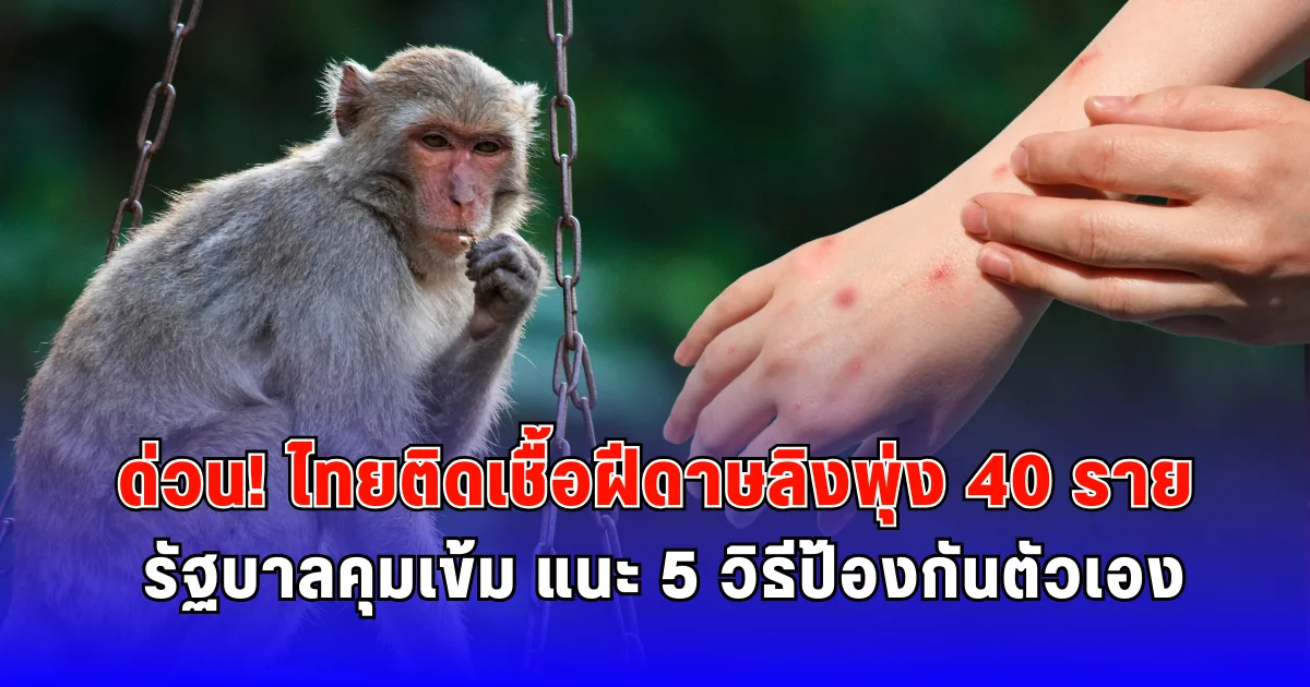 ด่วน ไทยติดเชื้อฝีดาษลิงพุ่ง 40 ราย รัฐบาลคุมเข้ม แนะ 5 วิธีป้องกันตัวเอง