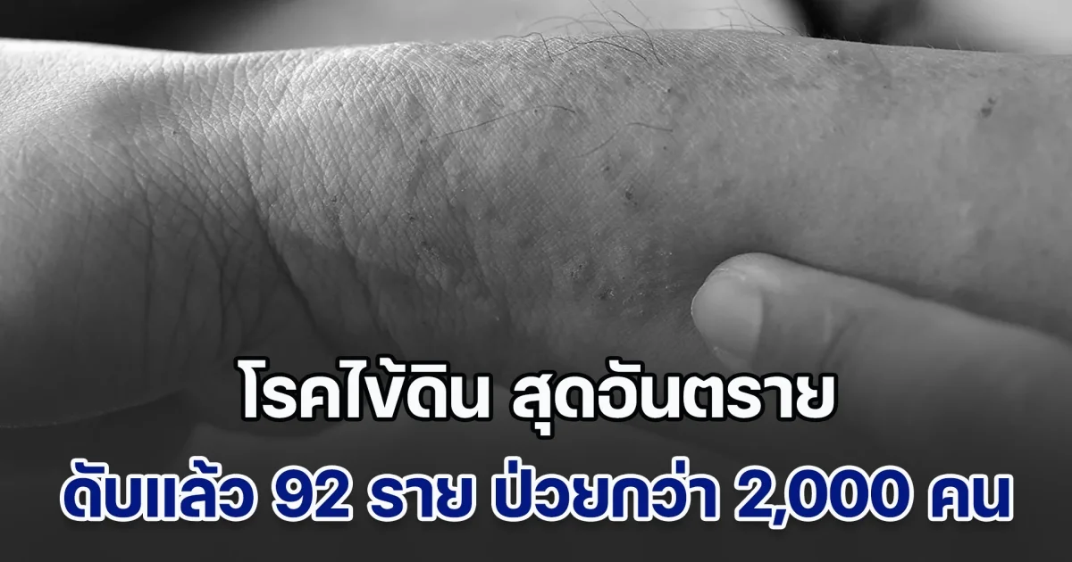 หน้าฝนต้องระวัง โรคไข้ดิน สุดอันตราย ดับแล้ว 92 ราย ป่วยกว่า 2,000 ราย เผยกลุ่มเสี่ยง