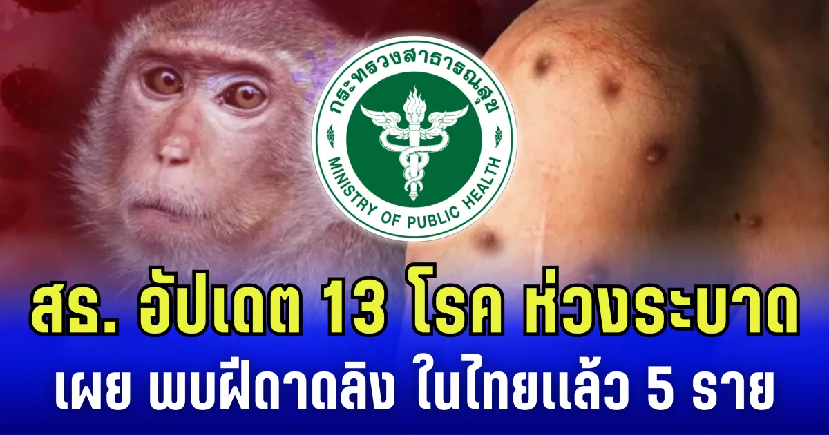 สธ. อัปเดต 13 โรค ห่วงระบาด เผย พบฝีดาดลิง ในไทยเเล้ว 5 ราย