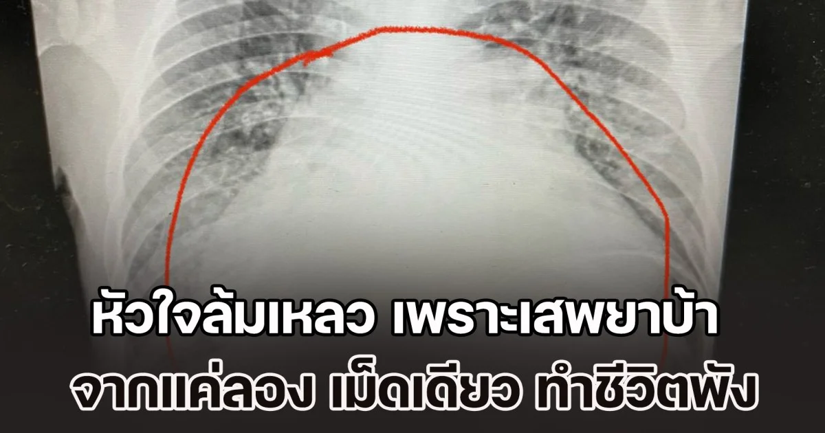 หมอเผยเคส หนุ่มวัย 22 ปี หัวใจล้มเหลว เพราะเสพยาบ้า จากแค่ลองเล่นๆ เม็ดเดียว ผ่านไป 2 ปี ทำชีวิตพัง เห็นแล้วเสียดายชีวิตแทน