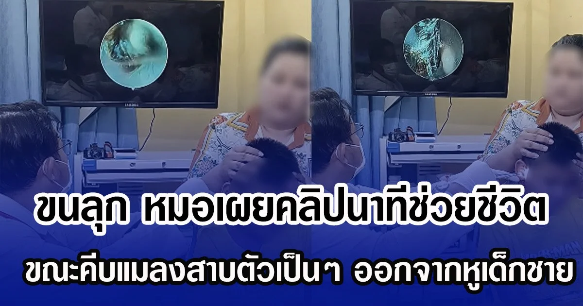 ขนลุก หมอเผยคลิปนาทีช่วยชีวิต ขณะคีบแมลงสาบตัวเป็นๆ ออกจากหูเด็กชาย (ข่าวต่างประเทศ)
