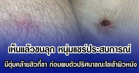 เห็นแล้วขนลุก หนุ่มแชร์ประสบการณ์ มีตุ่มคล้ายสิวที่ขา ก่อนพบตัวปริศนาขณะไชเข้าผิวหนัง