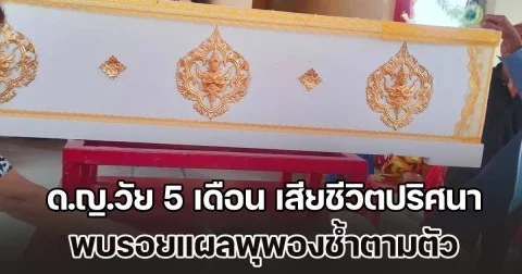 ด.ญ.วัย 5 เดือน เสียชีวิตปริศนา พบรอยแผลพุพองช้ำตามตัว ตรวจฉี่พ่อแม่เด็ก พบม่วงทั้งคู่ ผู้เป็นพ่อยันไม่ได้ทำร้ายลูก