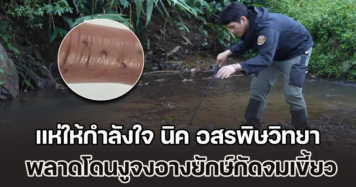 แห่ให้กำลังใจ นิค อสรพิษวิทยา พลาดโดนงูจงอางยักษ์กัดจมเขี้ยว หลังส่ง รพ. เกิดอาการแพ้เซรุ่ม