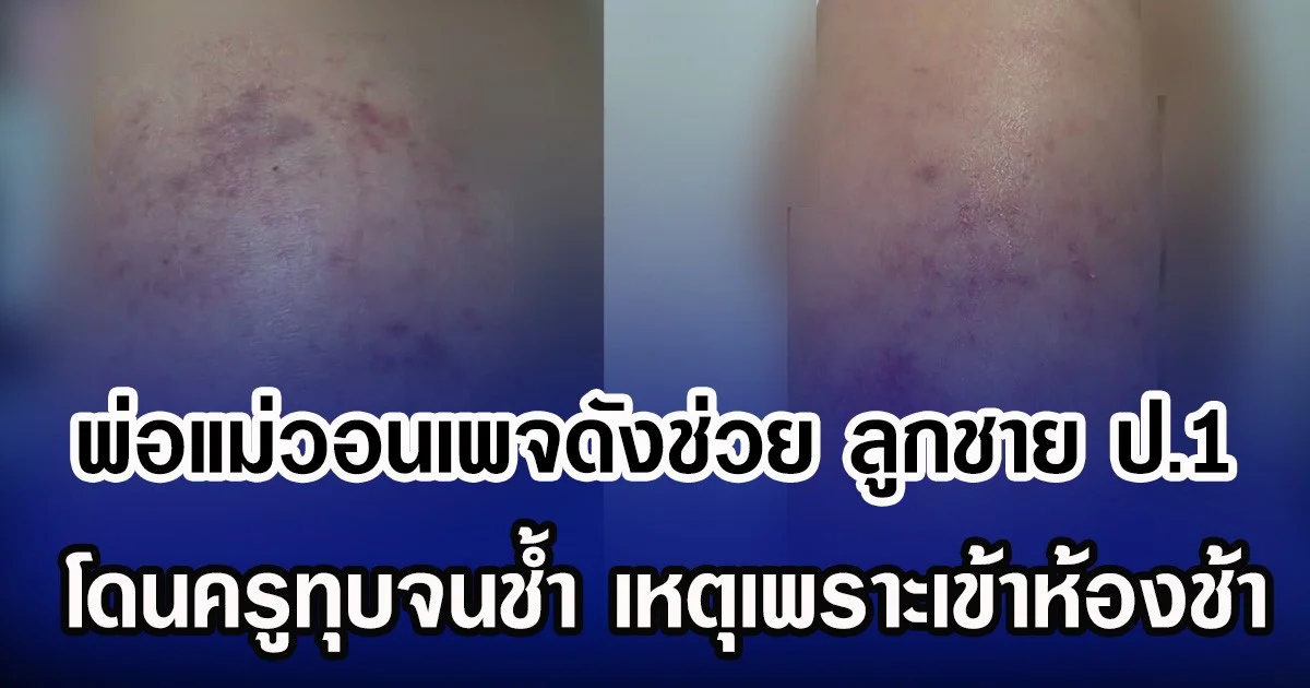 พ่อแม่วอนเพจดังช่วย ลูกชาย ป.1 โดนครูทุบจนช้ำ เหตุเพราะเข้าห้องช้า