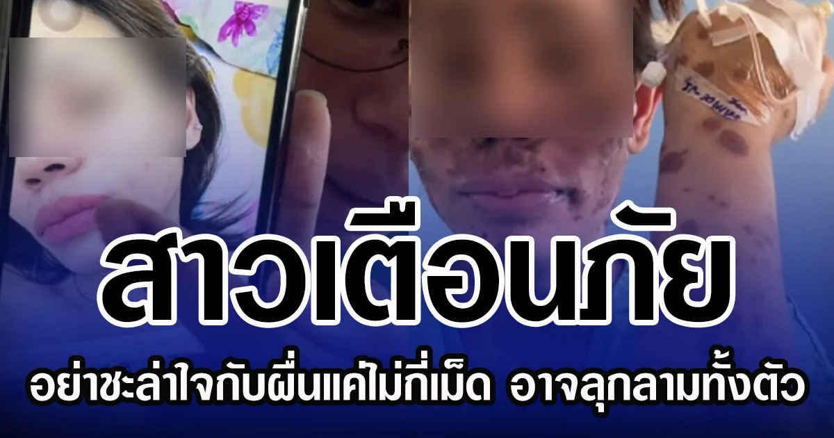 สาวเตือนภัย อย่าชะล่าใจกับผื่นแค่ไม่กี่เม็ด อาจลุกลามทั้งตัว
