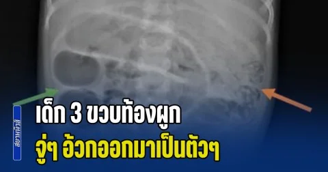 สะพรึง! เด็ก 3 ขวบท้องผูก จู่ๆ อ้วกออกมาเป็นตัวๆ หมอผ่าออกมา ยิ่งตกใจหนักมาก (ข่าว ตปท.)