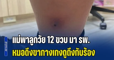แม่พาลูกวัย 12 ขวบ มา รพ. คิดว่าแค่ไข้หวัดใหญ่ หมอผิดสังเกต ดึงขากางเกงดูถึงกับร้อง สั่งส่ง ICU ด่วน (ข่าว ตปท.)