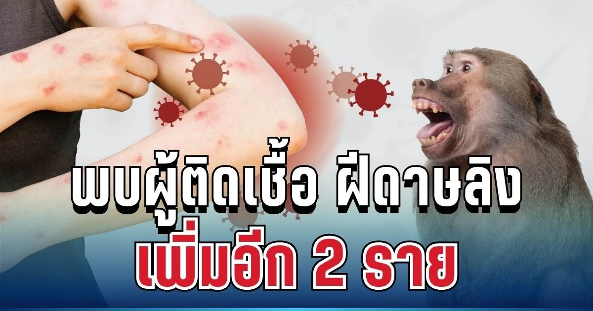ด่วน! พบผู้ติดเชื้อ ฝีดาษลิง เพิ่มอีก 2 ราย เปิดอาการล่าสุด