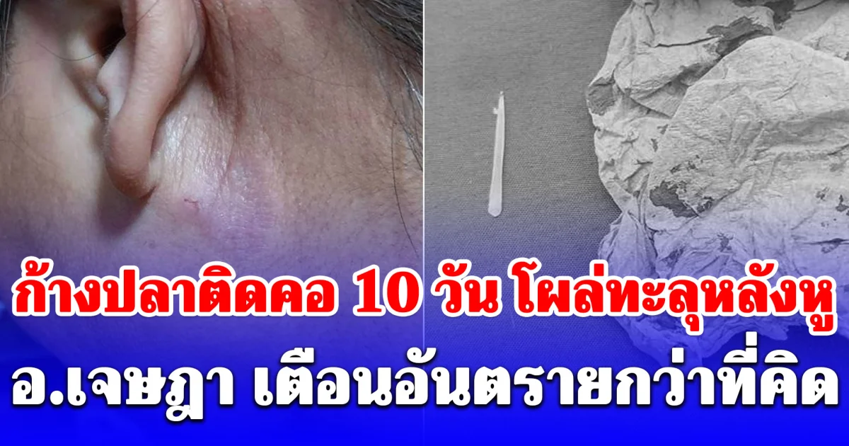อุทาหรณ์ใกล้ตัว! ก้างปลาติดคอ 10 วัน เคลื่อนตัวโผล่หลังหู อาจารย์เจษฎาเตือนอันตรายถึงชีวิต