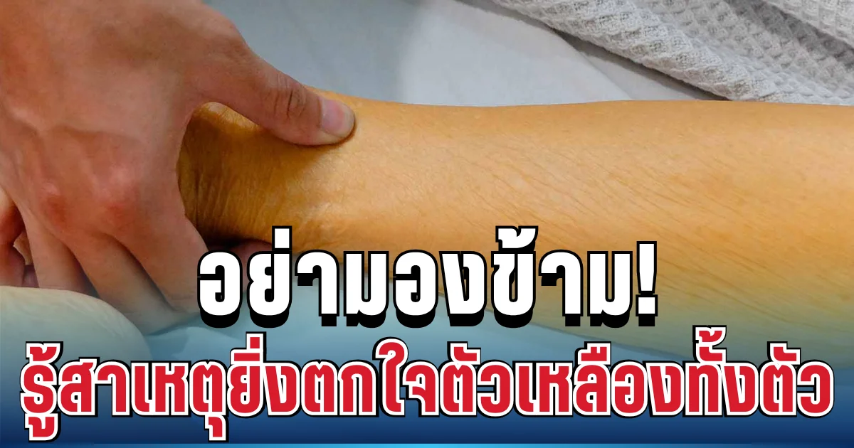 อย่ามองข้าม! สาวเล่านาทีชีวิต กินอะไรไม่ได้ ตัวเหลืองทั้งตัว รู้สาเหตุยิ่งตกใจ