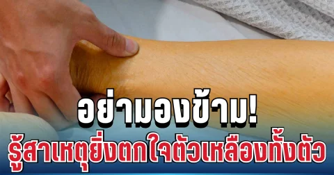 อย่ามองข้าม! สาวเล่านาทีชีวิต กินอะไรไม่ได้ ตัวเหลืองทั้งตัว รู้สาเหตุยิ่งตกใจ
