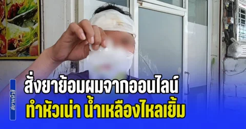 อุทาหรณ์! สั่งยาย้อมผมจากออนไลน์ ทำหัวเน่า น้ำเหลืองไหลเยิ้ม-หน้าตึง