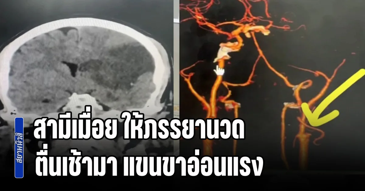 สามีเมื่อย ให้ภรรยานวด ตื่นเช้ามา แขนขาอ่อนแรง พูดไม่ได้ หมอสแกนสมอง เห็นผลแล้วช็อก