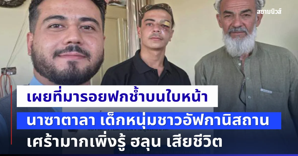 ตกใจเลย เผยที่มารอยฟกช้ำบนหน้า นาซาตาลา หนุ่มชาวอัฟกานิสถาน