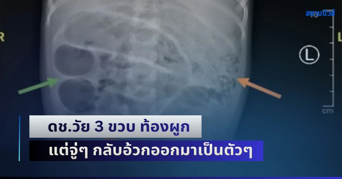 สุดสะพรึง! ดช.วัยเพียงแค่ 3 ขวบ เกิดอาการท้องผูก แต่จู่ๆ กลับอ้วกออกมาเป็นตัวๆ หมอผ่าออกมา ยิ่งตกใจหนักมาก (ข่าว ตปท.)