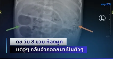 สุดสะพรึง! ดช.วัยเพียงแค่ 3 ขวบ เกิดอาการท้องผูก แต่จู่ๆ กลับอ้วกออกมาเป็นตัวๆ หมอผ่าออกมา ยิ่งตกใจหนักมาก (ข่าว ตปท.)
